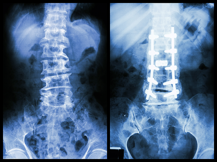 "Spondylosis" (Left image) , internal fixation. (Right image) back injury - Springfield, IL